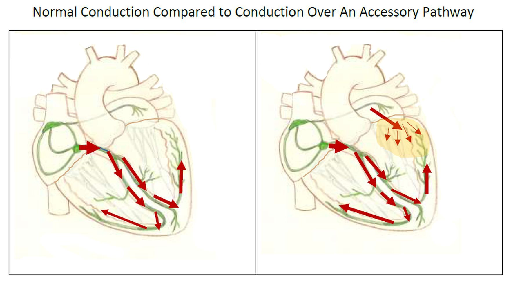 Accessory pathway | ECG Guru - Instructor Resources